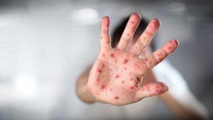 Jornada para médicos y enfermeros sobre el Herpes Zóster Jornada para médicos y enfermeros sobre el Herpes Zóster