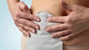 Llamamiento para atender a ostomizados en Ucrania