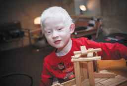 13 de junio: Día Internacional de Sensibilización sobre el Albinismo